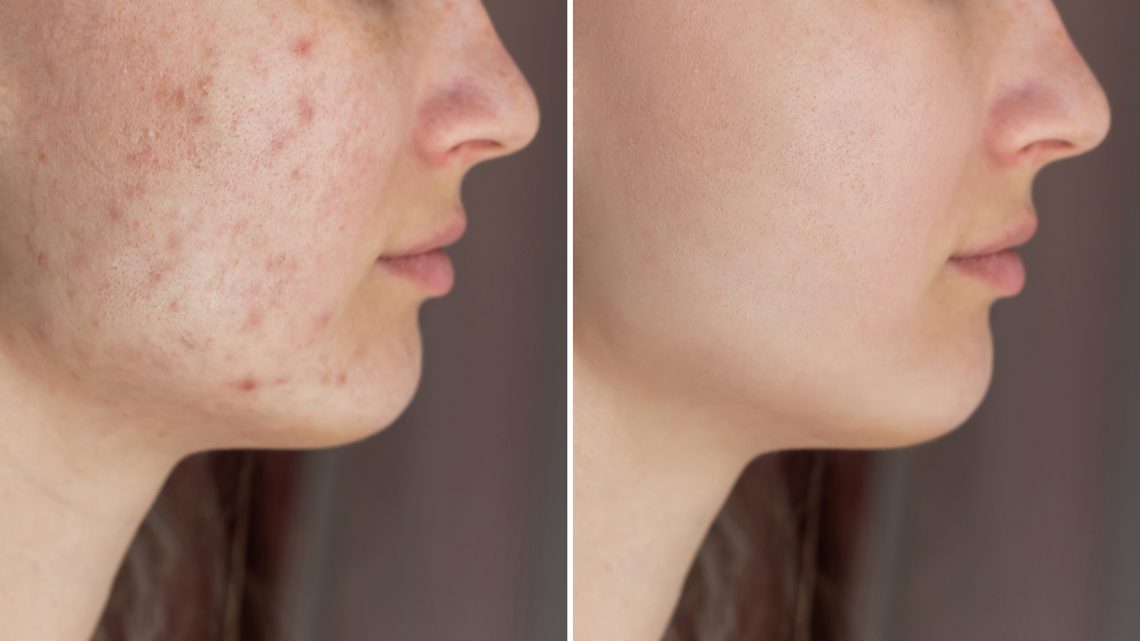 What Is the Best Acne Treatment for Different Skin Types?
